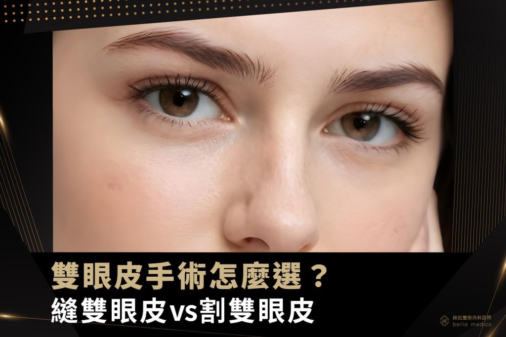 雙眼皮手術怎麼選
